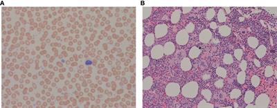 Case report: Peri-procedural hydroxyurea helps minimize bleeding in patients with Essential Thrombocythemia associated with acquired von Willebrand syndrome